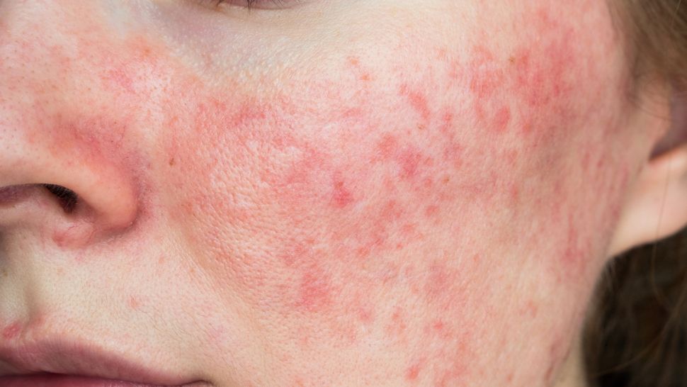 Rosacea: hogyan lehet enyhíteni a bőrpírt?